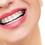 La ortodoncia en adultos: métodos de tratamiento y costos
